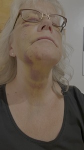Bruises increased